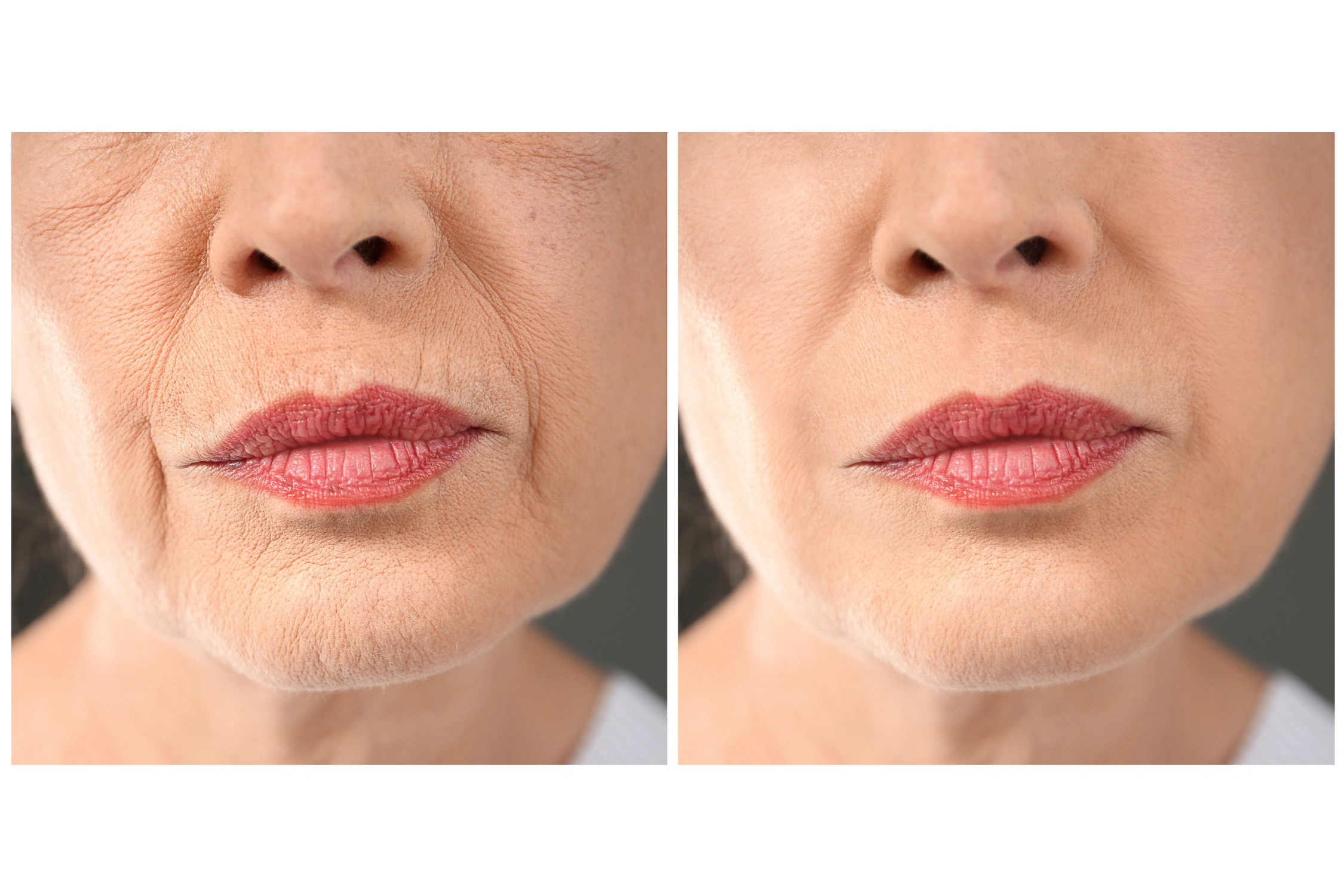 Wrinkle treatment