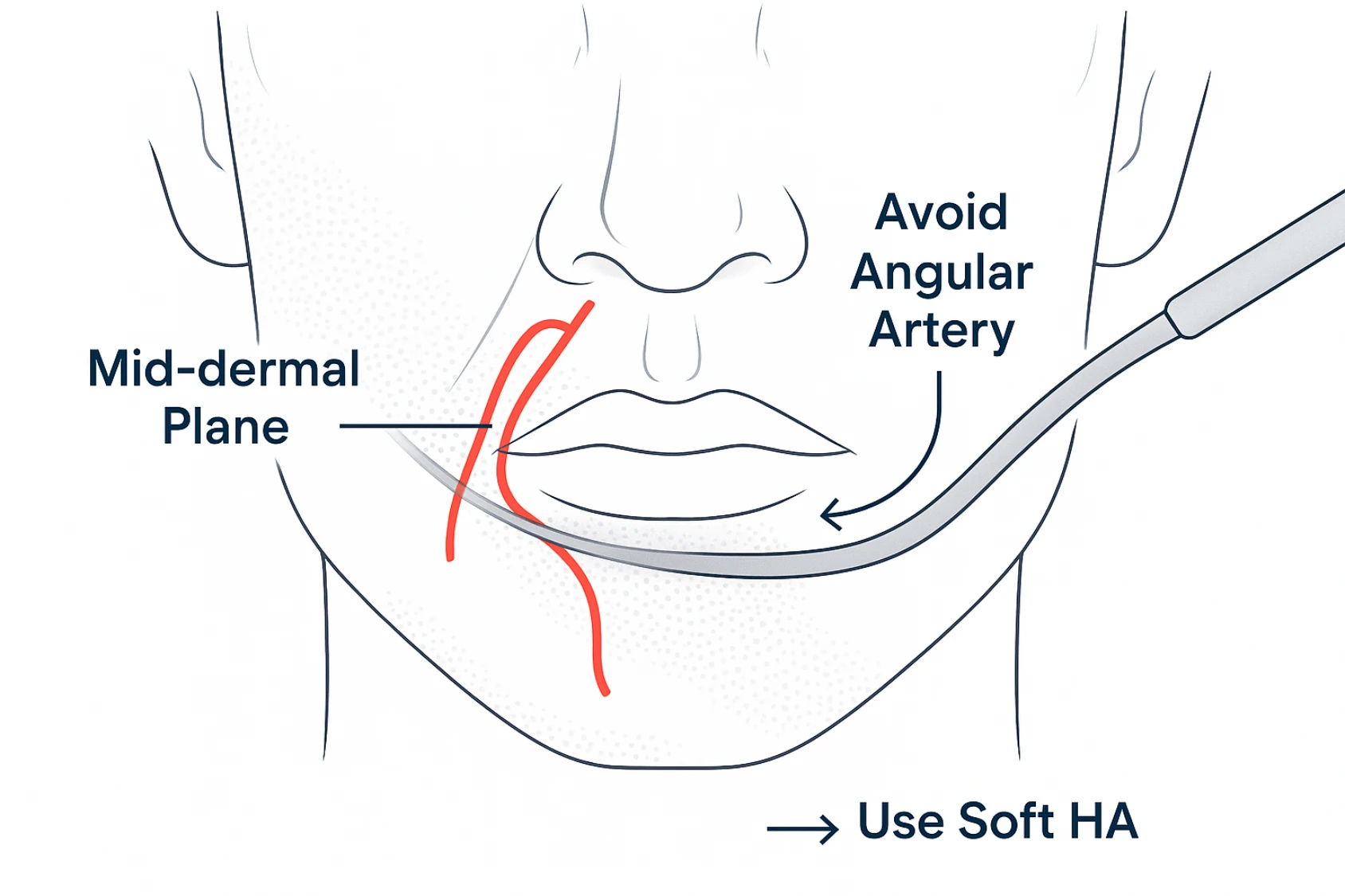 Front‑facing nasolabial fold diagram showing cannula placement avoiding angular artery in safe filler injection techniques