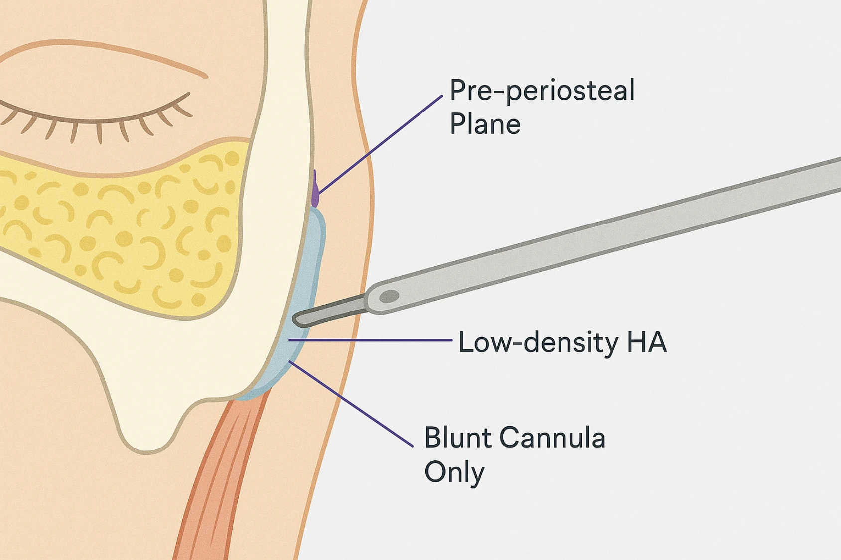 Under‑eye tear trough cross‑section showing blunt cannula placement in pre‑periosteal plane for safe filler injection techniques
