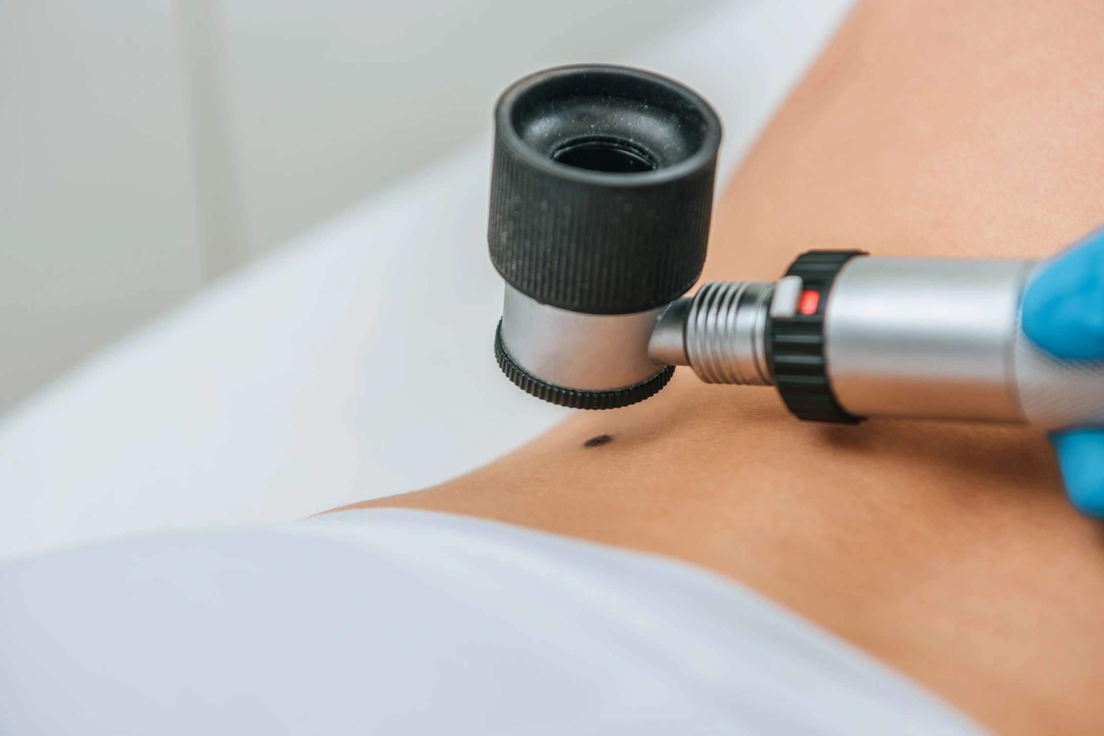 Mole Removal