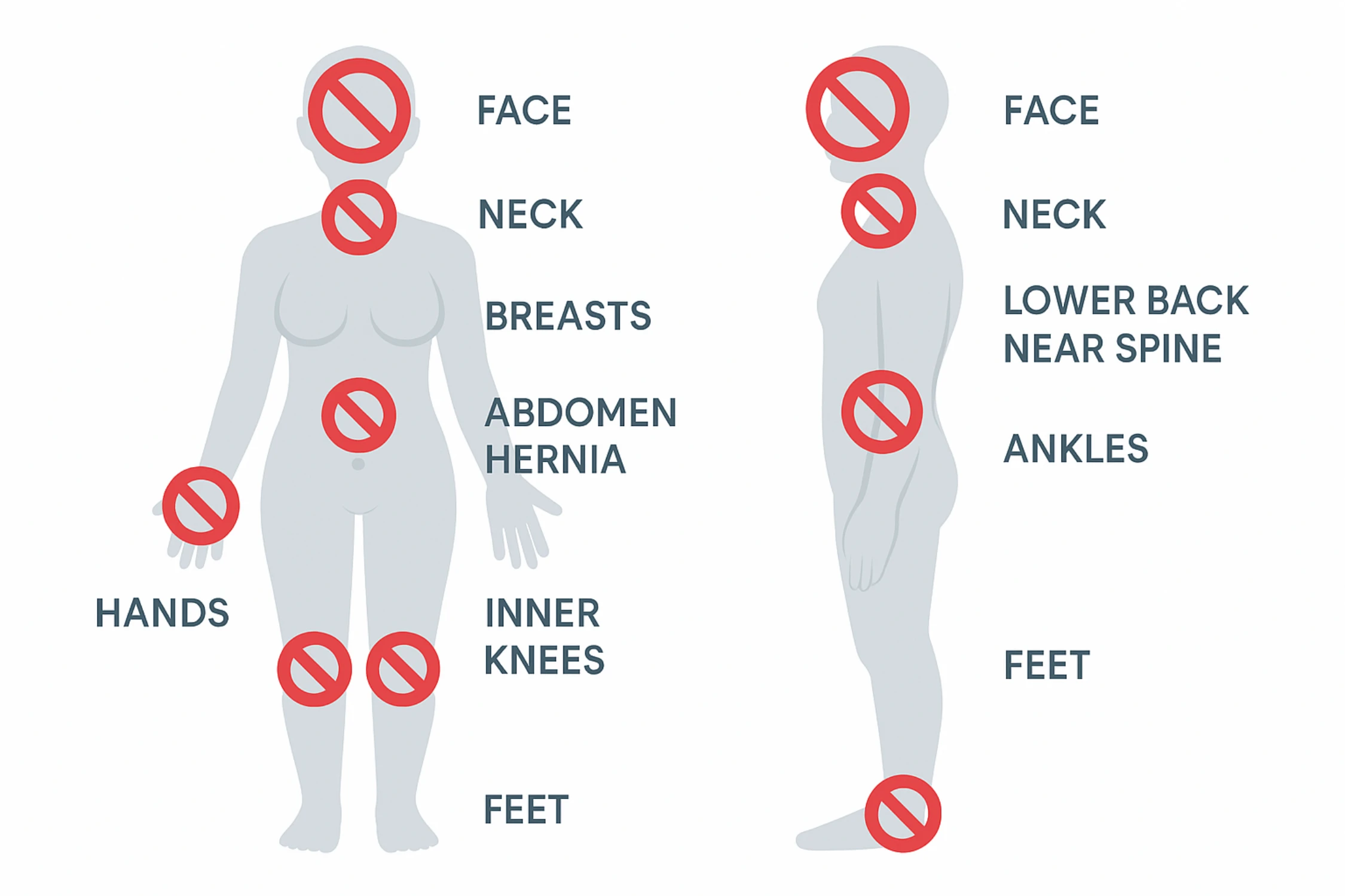 Infographic silhouette highlighting cryolipolysis no‑go zones: face, neck, chest, lower back, hands, feet, inner knees, ankles, hernia site