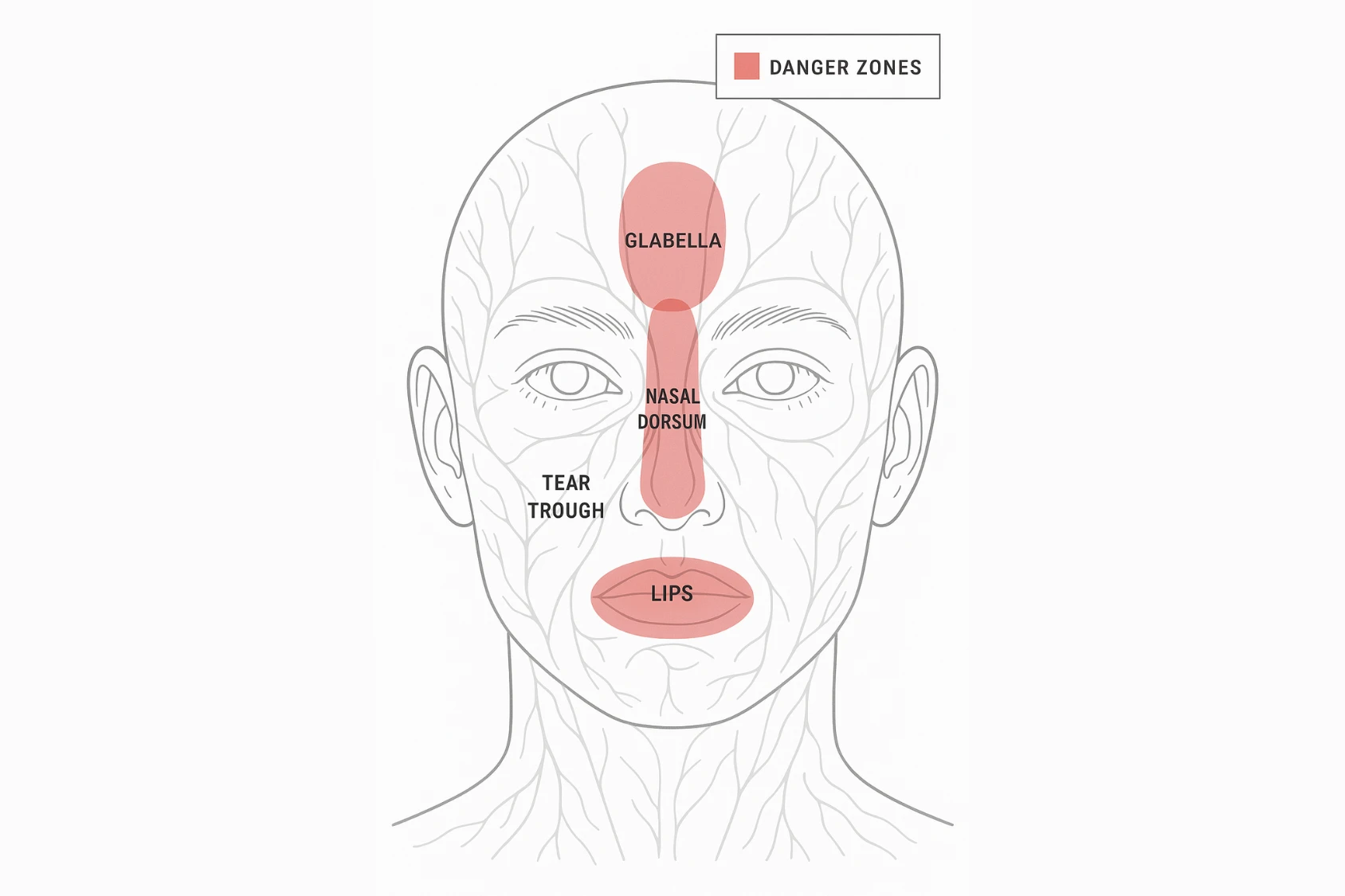 Frontal face map with red highlights on glabella, nasal dorsum, tear trough, lips danger zones for safe filler injection techniques
